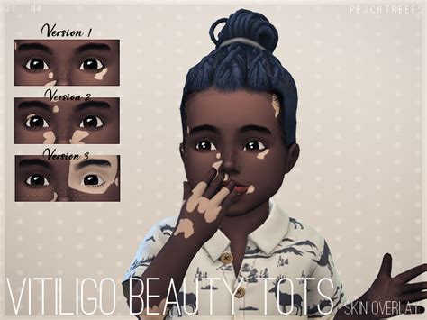 The Sims Resource Vitiligo Beauty Skin Overlay Toddlers N4