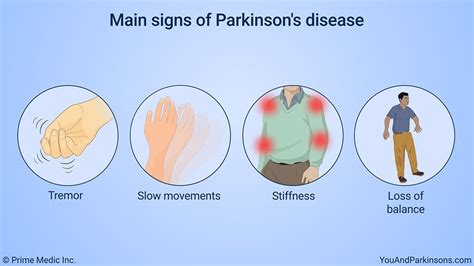 Pin On Animated Parkinsons Patient