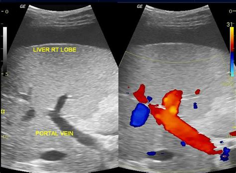 cirrhosis echocardiography  ultrasound wikidoc