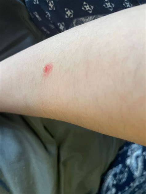 Random Red Spot On Arm Medizzy