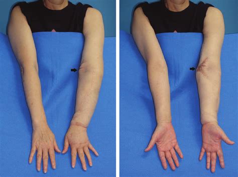 Lymph Nodes Around Elbow