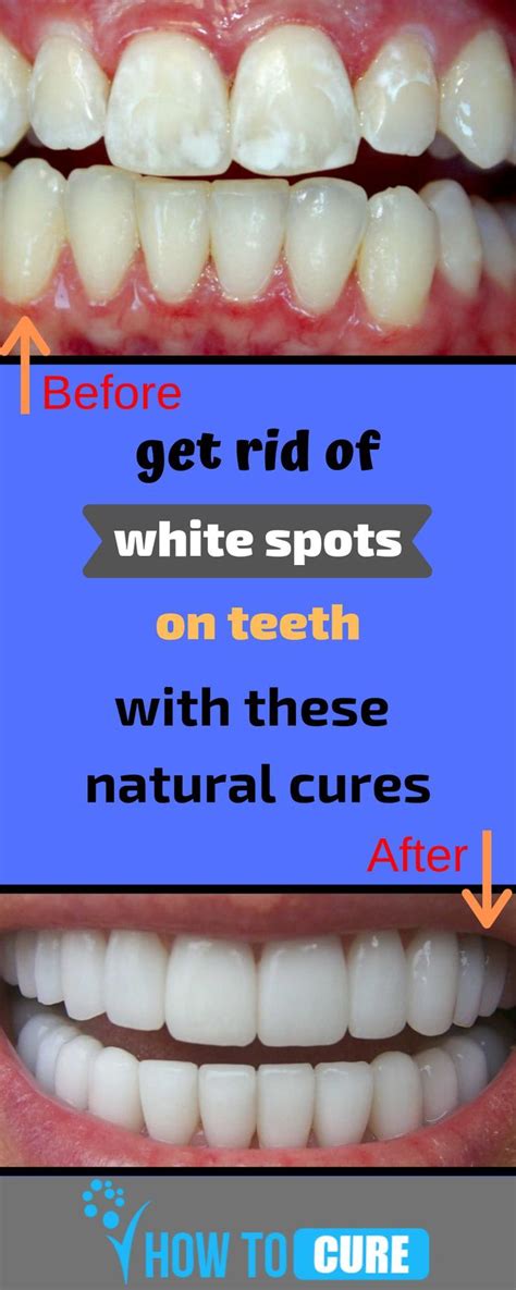 How To Get Rid Of White Spots On Teeth At Home Pin On Makeup