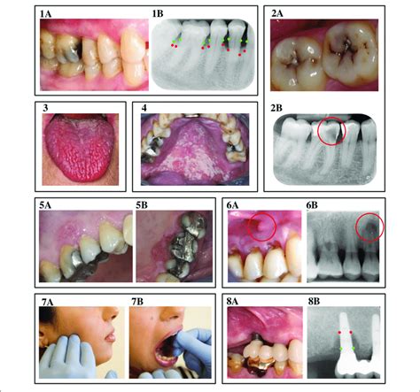 Oral Complications Of Diabetes Mellitus 1a And 1b Periodontitis A