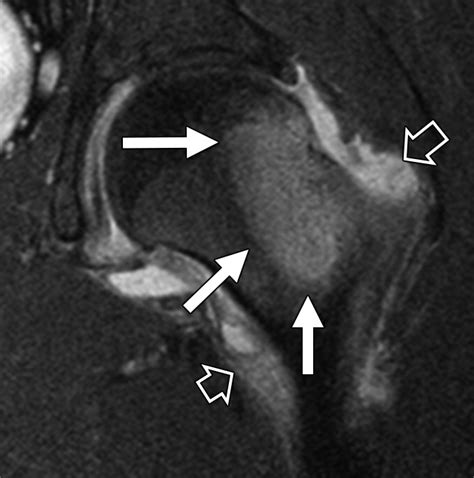 Osteoid Osteoma Of The Femoral Neck Use Of The Half Moon Sign In Mri