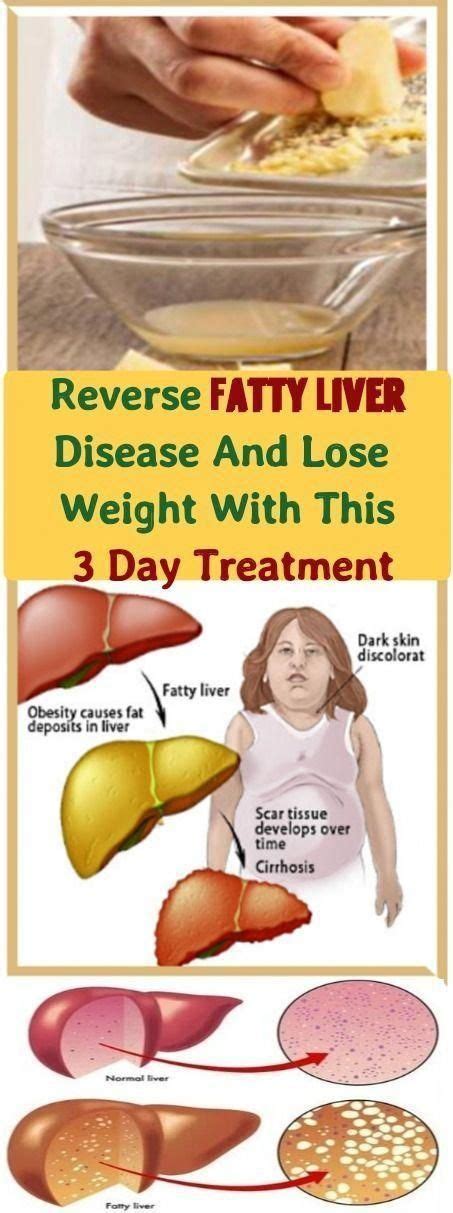 Liver Detox Cleanse Liverdetox Fatty Liver Disease Liver Detox