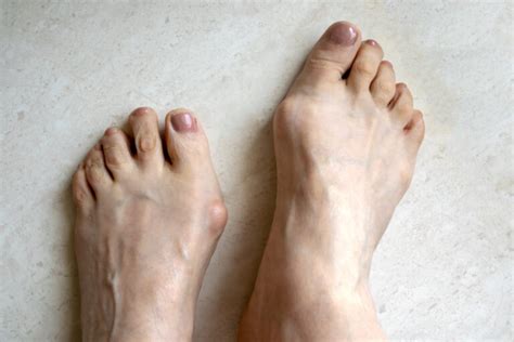 Big Toe Arthritis Hallux Rigidus Dr Bijan 4 Feet