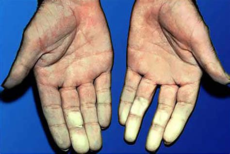 Raynauds Disease Causes Symptoms Treatment