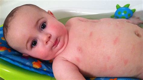Which Baby Rashes Require Treatment Symptoms Of Baby Rashes Youtube