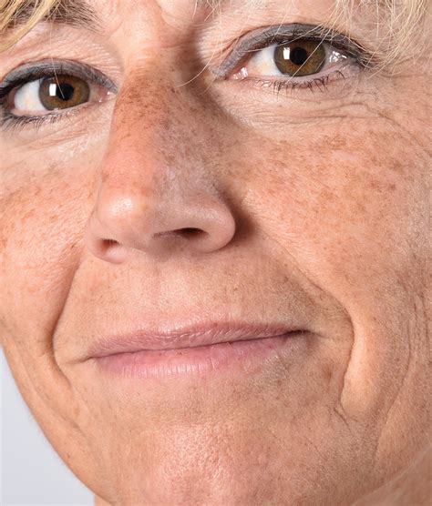 Aging Skin Treatments Los Angeles Refresh Med Spa La