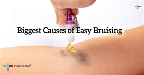 Top Reasons You Bruise Easily