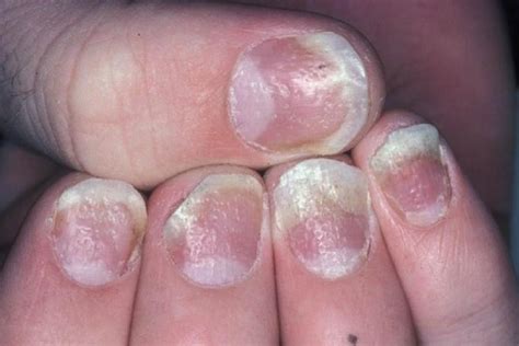 Psoriasis Of The Nails All You Need To Know Psoriasis Las Uñas Uñas