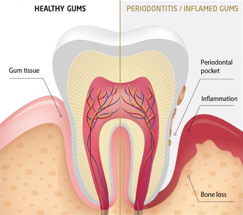 How Are Periodontal Diseases Treated