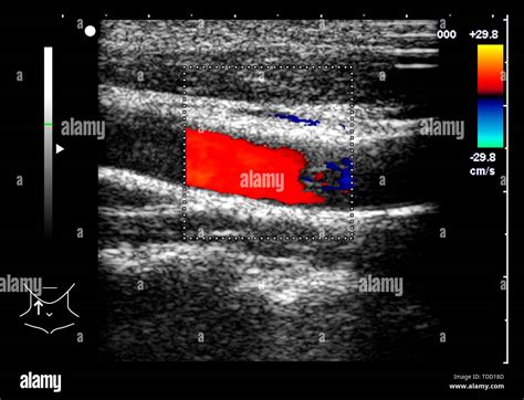 Carotid Artery Doppler Ultrasound Scan Stock Photo Alamy