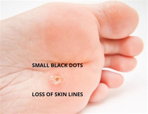Plantar Warts On Feet Pictures Remedies