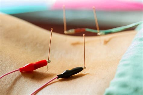 What Is Electro Acupuncture And How Can It Help Me Lucy Clarke