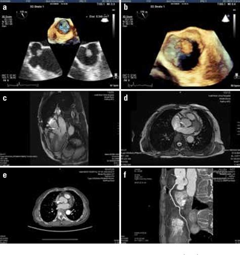 Figure 1 From Cardiac Calcified Amorphous Tumor Originating From The