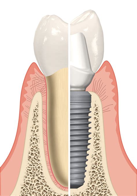 It's softer than enamel and dentin; Dental Implant Center Los Angeles | LA Periodontists
