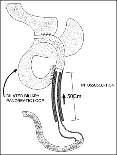 Trapped Among The Waves Massive Jejunojejunal Intussusception After Gastric Bypass The