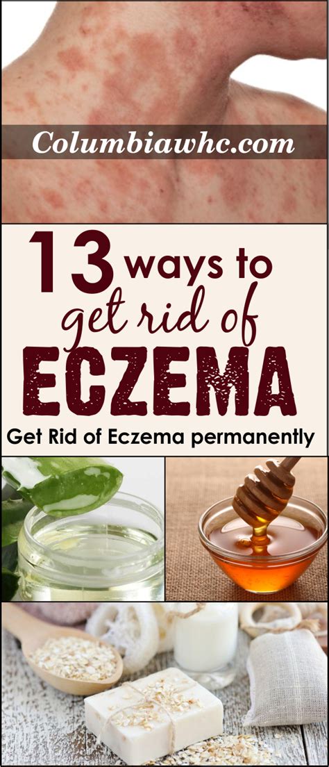 13 Amazing Ways To Get Rid Of Eczema Very Fast At Home Get Rid Of Eczema Eczema Eczema Remedies