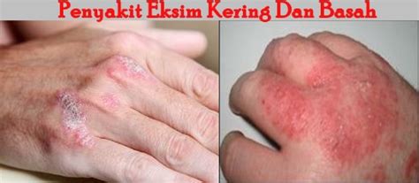 We did not find results for: Jual Obat Gatal Kulit / Alergi / Eksim Dermatitis - Podo ...