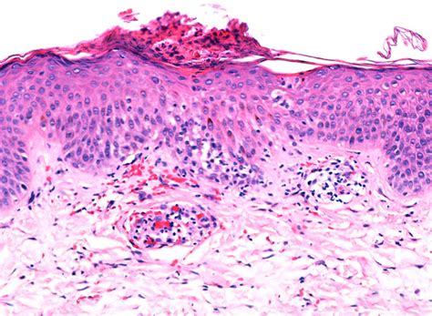 Acanthosis Of The Epidermis Associated With Spongiosis Erythrocyte