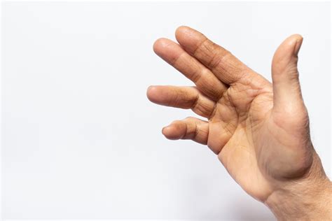 What Is Dupuytrens Contracture Centennial Orthopedics And Podiatry