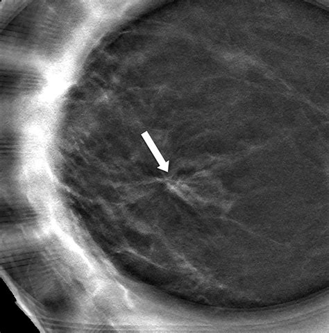 Management Of Architectural Distortion On Digital Breast Tomosynthesis
