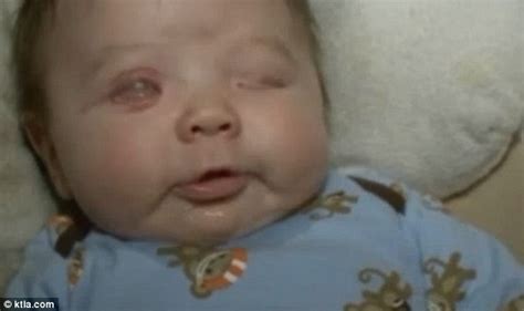 Baby Born Without Eyes Hospital Staff Stunned But Parents Hopeful