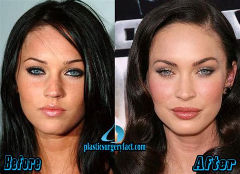 During this part of the procedure, your. Megan Fox Before After Plastics Surgery | Megan Fox Tattoo ...