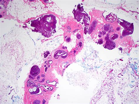 Pathology Outlines Intraductal Papilloma