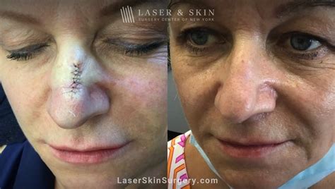 scar revision reconstructive laser ny