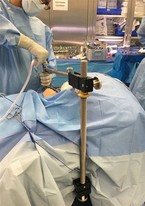 Gasless Trans Axillary Robotic Thyroidectomy The Technique And