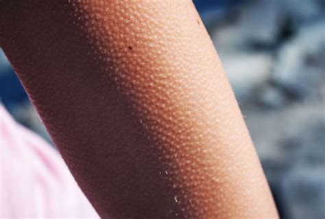 Goosebumps May Be A Side Effect Of Hair Follicle Muscles Scientists