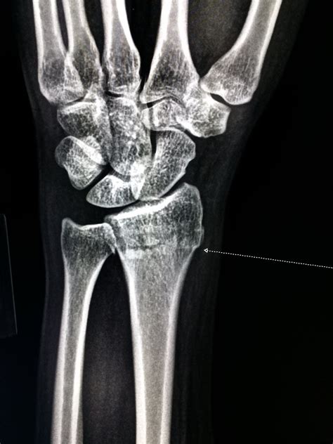X Ray Broken Bones