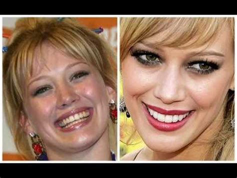 Before And After Celebrity Smiles Youtube
