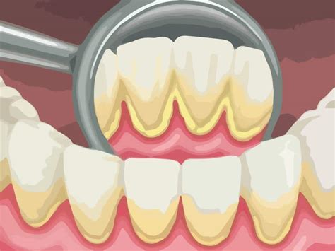Dental Plaque And Tartar How Deep Teeth Cleaning Treats Gum Disease