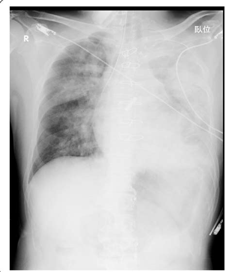 Chest Xray Chest Xray Showing Massive Diffuse