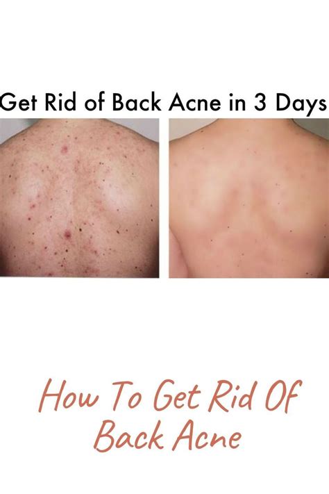 How To Get Rid Of Back Acne How To Get Rid Of Acne Acne How To Get