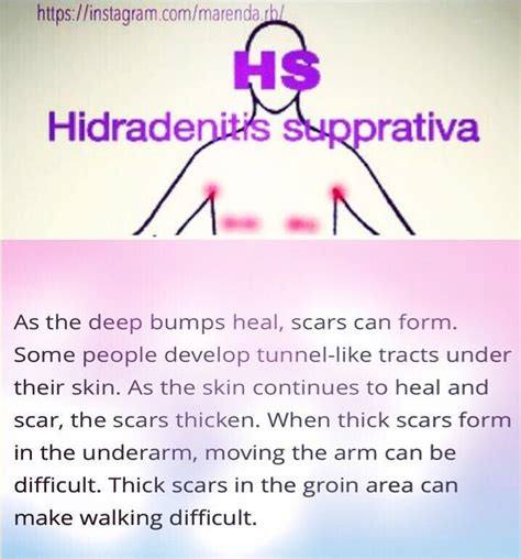 Hidradenitis Hidradenitissuppurativa Acneinversa Skincondi In 2020