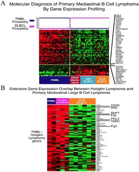Gene Expression Profiling Of Primary Mediastinal B Cell Lymphoma Pmbl