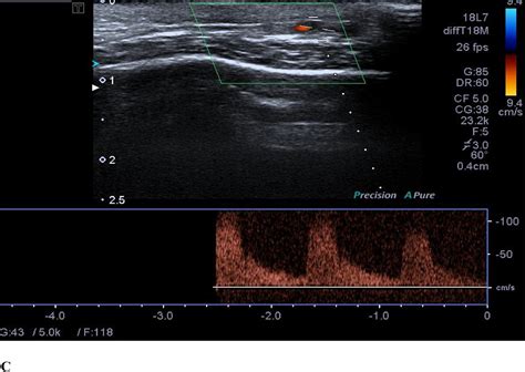 Temporal Artery Ultrasound To Diagnose Giant Cell Arteritis A