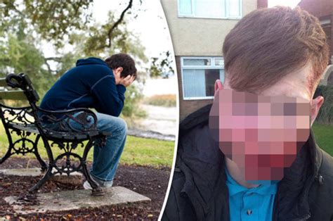 Graphic Pics Bullied Schoolboy Left With Horrific Face Injuries In