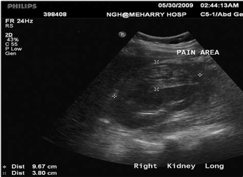 Ultrasound Showing A Large Perinephric Haematoma Measuring About 96 ×
