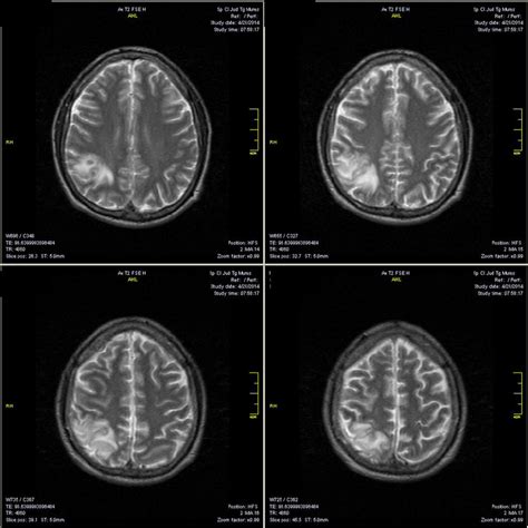 Brain Mri T2 Sequences In A 30 Years Old Male Patient With Sinus
