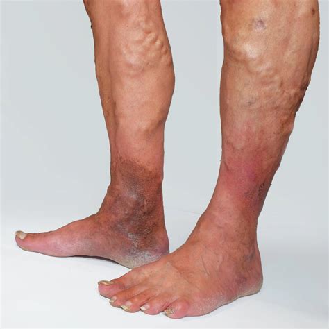 Skin Changes In Venous Insufficiency Laurel Clinical