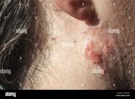 Cancer Skin Hi Res Stock Photography And Images Alamy