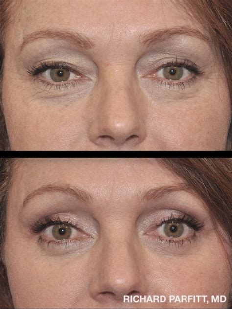 Blepharoplasty Photo Gallery Before And After Eyelid Surgery Photos