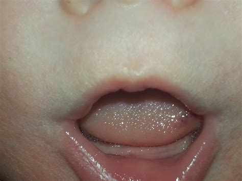 Dark Spot On Los Tongue Pip — The Bump
