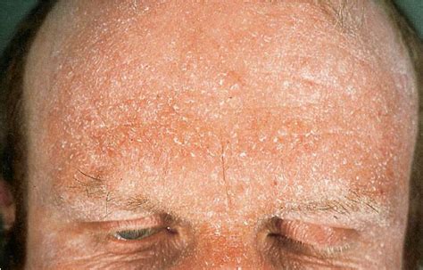 How Long Does Irritant Contact Dermatitis Last Eczema Atopic