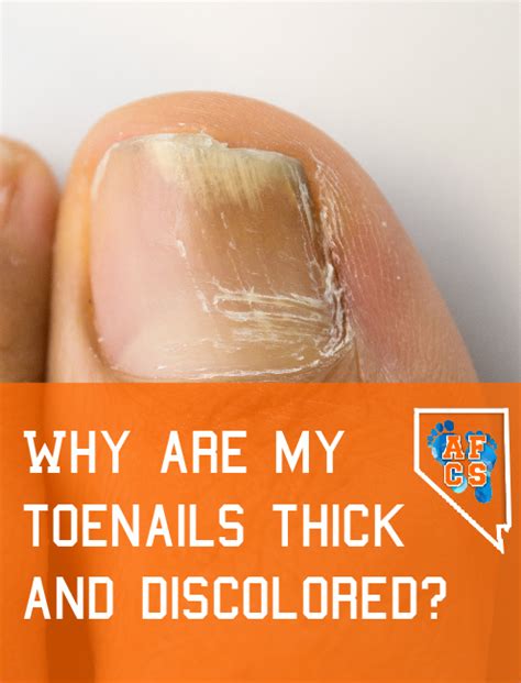 Thick Discolored Toenails Absolute Foot Care Specialists